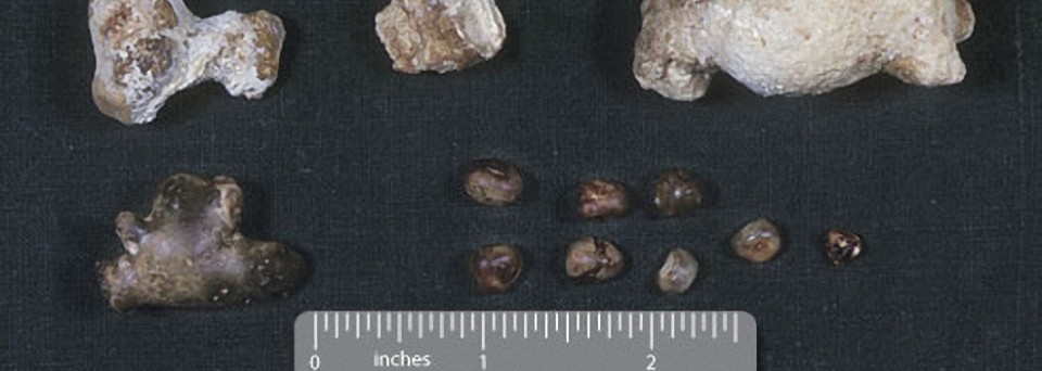 10.Анализ почечных камней